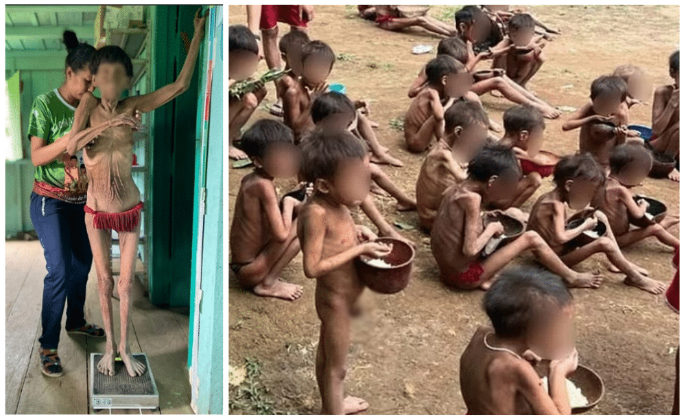 DESUMANO: DESNUTRIÇÃO SEVERA em famílias inteiras, é o quadro na tribo Yanomami